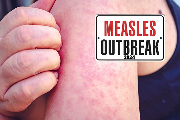 attachment-Measles Outbreak 2024
